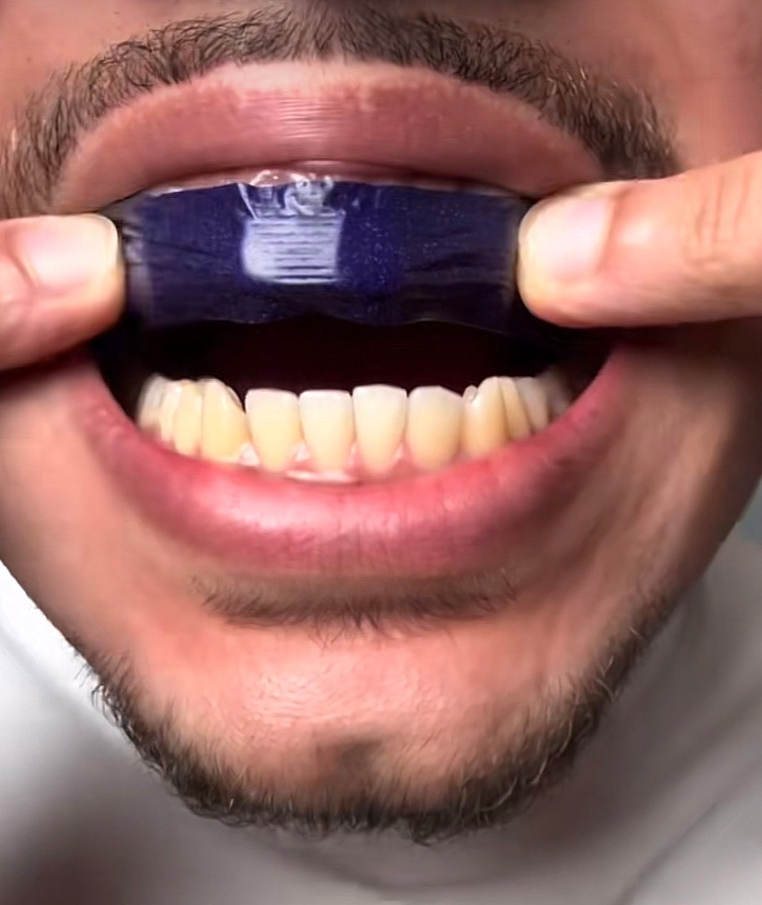 🟣 ÉTAPE 1 — Pose la bande violette directement sur tes dents propres et sèches. Ajuste bien pour qu’elle colle parfaitement.