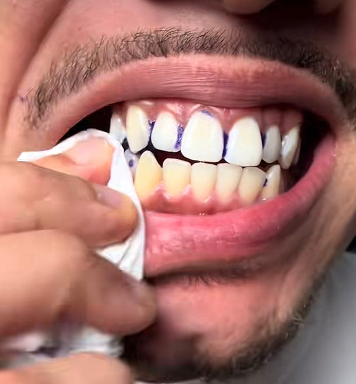 🟣 ÉTAPE 3 — Retire la bande puis essuie délicatement les dents avec un mouchoir propre. Admire ton sourire éclatant ✨